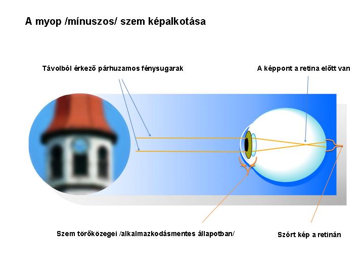 Pontosan mit jelent a pluszos és a minuszos szemüveglencse?, Mínusz és plusz látás